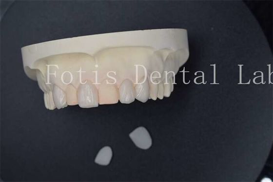 Carillas de laboratorio dentales artificiales personalizadas con resistencia a manchas superior