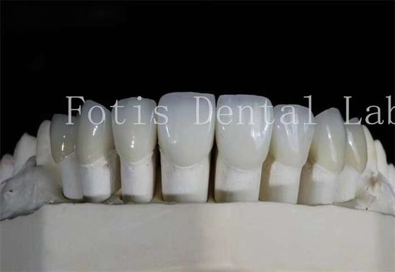 Las carillas de laminado dental pulido de alta translucidez para sonrisas de aspecto natural
