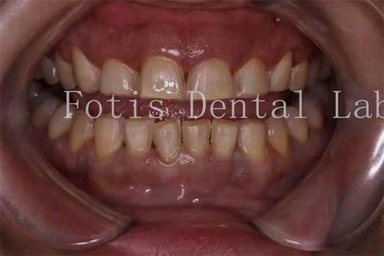 Fabricación personalizada de carillas de dientes de porcelana con una textura de superficie lisa