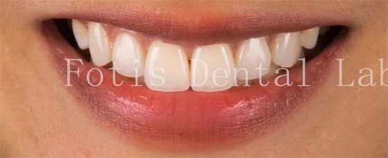 Carillas de dientes cosméticos de alta gama para una perfecta resistencia a las manchas de la sonrisa