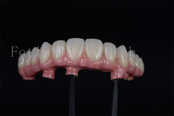 Restauración de la capacidad de masticación con 4 o 6 implantes
