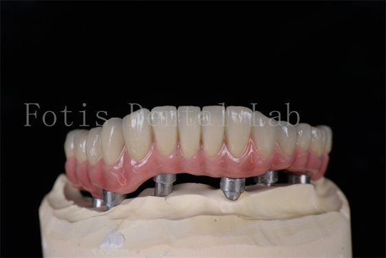 Minimamente invasivo el mismo día todos en 4 todos en 6 implantes naturales que se ven fáciles de limpiar