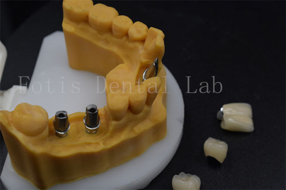 Coronilla de implante dental de alta durabilidad fácil de ajustar Guía de manchas de implante dental