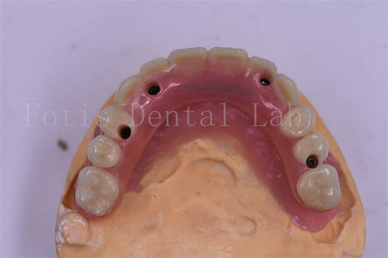 Implante dental de titanio con corona dental de precisión
