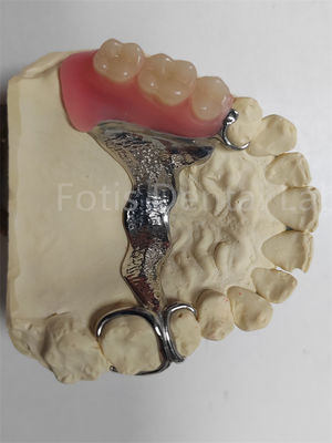 Dentadura parcial extraíble resistente a los olores muy ajustable