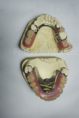 La dentadura parcial superior extraíble requiere mantenimiento regular