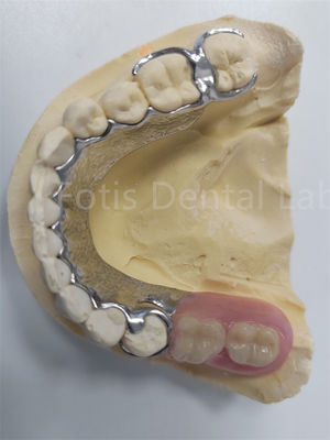 Reemplazar los dientes faltantes Dentadura parcial extraíble Prótese dental Diseño flexible