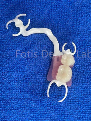 Dentadura parcial extraíble confortable y personalizable para reemplazar dientes estables