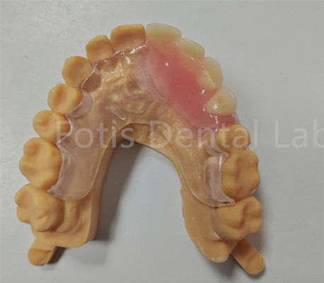 Aplicación dental TCS parcial con ajuste de comodidad hipoalergénico