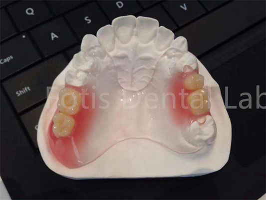 Aplicaciones dentales TCS flexibles Valplast Confortable Diseño duradero