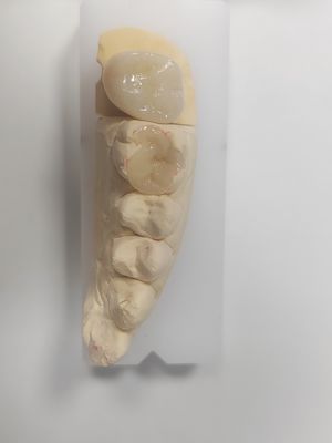 Incrustación y incrustación dental para el relleno indirecto y la restauración del color de los dientes