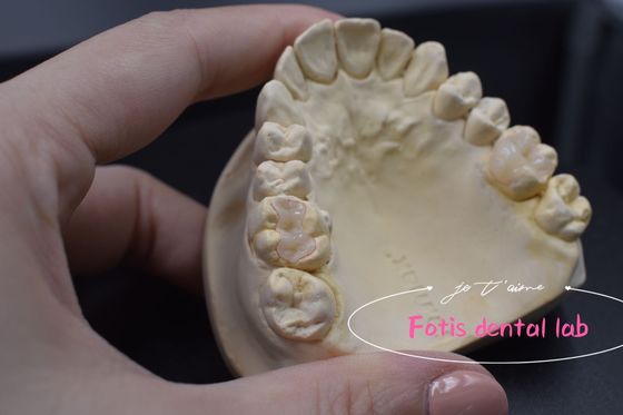 Aplicaciones versátiles de incrustaciones y onlay dentales modernas personalizables