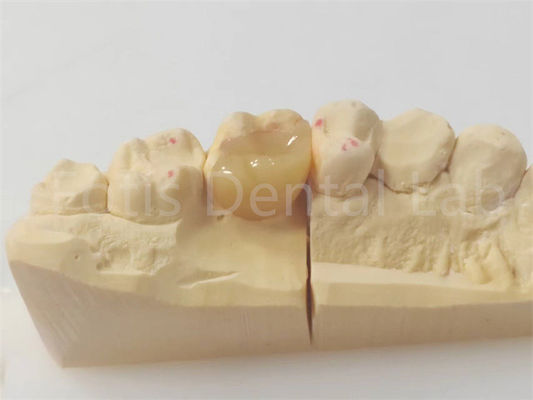 Incrustación dental de precisión para restauraciones precisas y duraderas