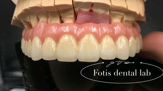 Restauración confiable PFM coronas dentales de porcelana fundida a la corona de metal personalizada