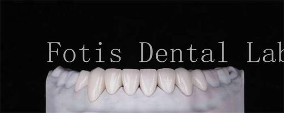 Alta durabilidad Veneers de dientes de aspecto natural 0,3 mm-0,5 mm de espesor
