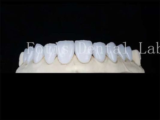 Carillas de porcelana natural personalizadas Carillas de laboratorio dental Resistentes a manchas