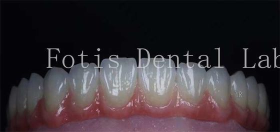 Superficies suaves Revestimientos de dientes cosméticos Carillas de porcelana natural personalizables