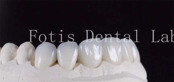Las carillas de laminado dental translúcidas ultra fuertes de color natural