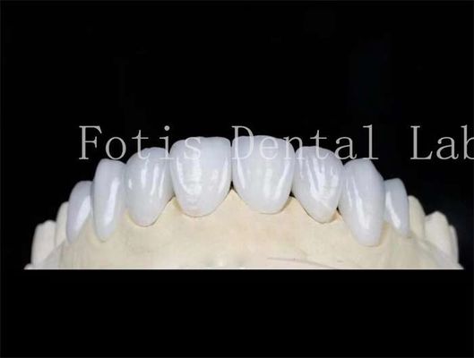 Laminado dental de color natural Veneers de dientes falsos Veneers con cemento de unión