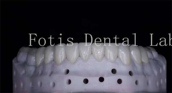 OEM ODM Resistente a las manchas Veneers de porcelana de aspecto natural Alta resistencia