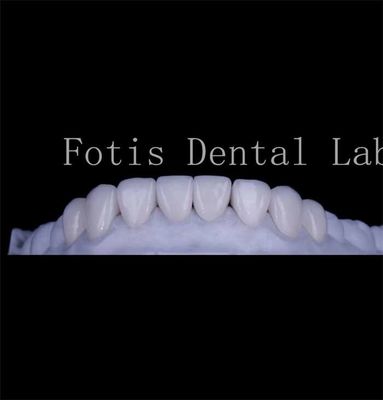 Con una textura lisa y duradera, cubre los dientes con carillas naturales