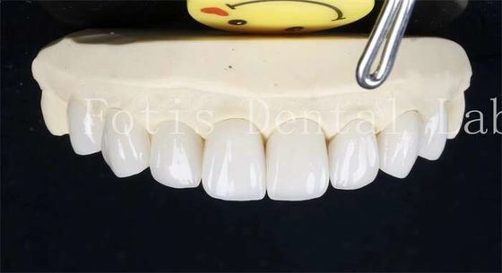 0.3-0.5mm Dentes de cerámica laminada Veneers de dientes falsos con cemento adhesivo de unión