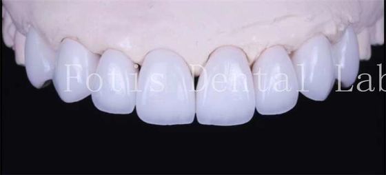 Cementos adhesivos de unión carillas blancas naturales con alta translucidez