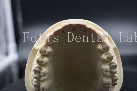 Carillas de dientes artificiales de alta resistencia Dentista Carillas de porcelana de aspecto natural