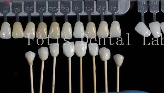 Personalización Veneces dentales naturales Dentes falsos superpuestos Alta resistencia