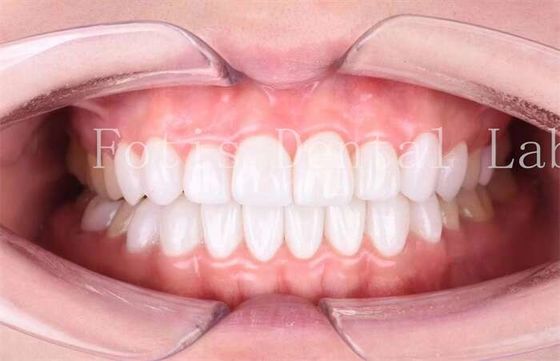 Las carillas de laminado dental de alta translucidez