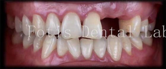 Carillas dentales temporales naturales personalizadas para una sonrisa hermosa