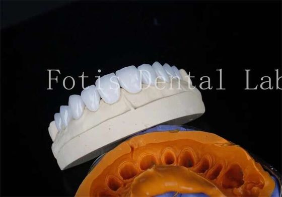 Cementos de unión de carillas de laboratorio dentales de porcelana para restauraciones duraderas