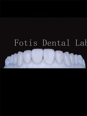 Las carillas dentarias de porcelana de alta translucidez mejoran su sonrisa de manera natural