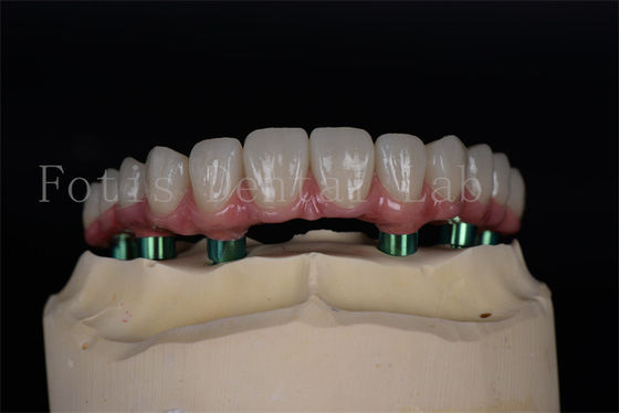 Titanio/circonio de larga duración Todos en 4/6 Implantes Fácil mantenimiento Alta tasa de éxito