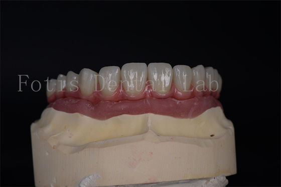 Estética natural con implantes todo en 4 y todo en 6