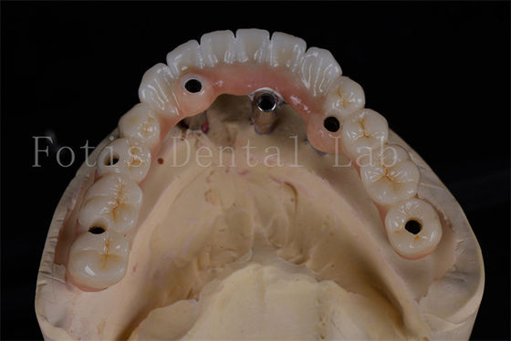 Tasa de éxito Implantes dentales todos en 4 Procedimiento del mismo día Restauración completa de la masticación asequible