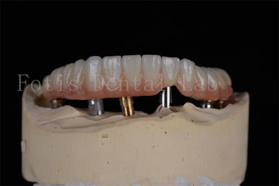 4 o 6 implantes de arco completo tasa de éxito solución mínimamente invasiva
