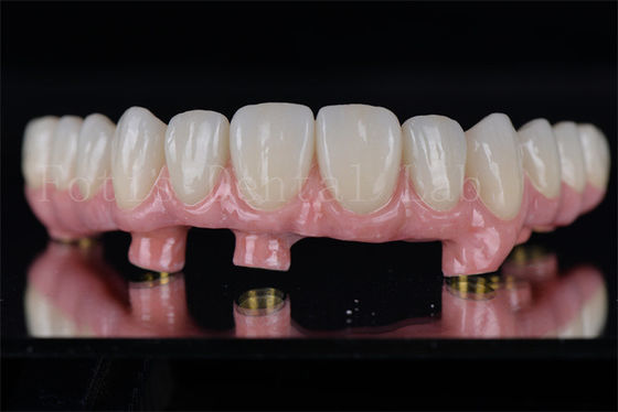 Los implantes dentales individuales de todos los 4 y todos los 6 restauran la capacidad de masticación completa.