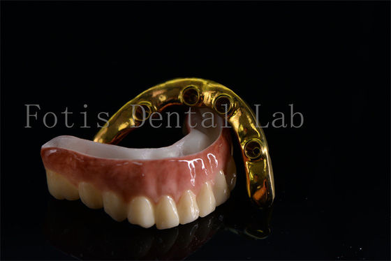 Implantes dentales a precios asequibles Tratamiento eficaz y fácil de limpiar