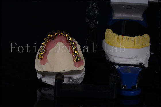 Implantes dentales de titanio / zirconio a un precio asequible para sonrisas naturales