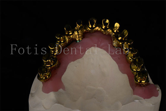 Implantes dentales de aspecto natural restauran la capacidad de masticar