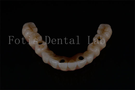 Reemplazo de implantes dentales avanzados para una funcionalidad óptima