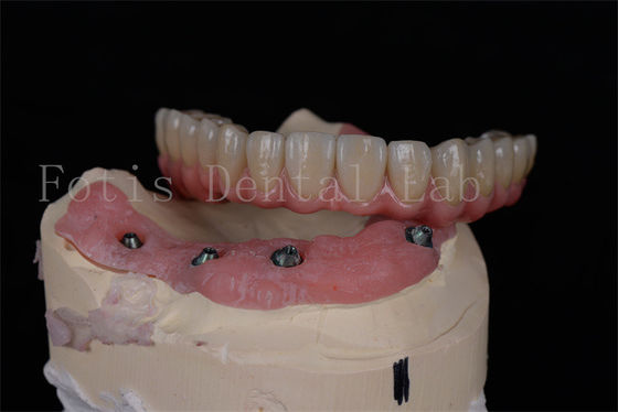 Implantes dentales personalizados para rehabilitación oral completa