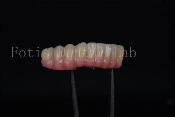 Rápido y eficaz todo en cuatro todo en seis en un día implantes seguridad garantizada