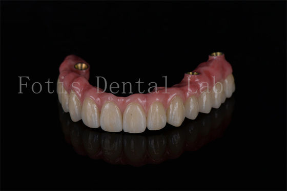 Restauración de arco completo todo en cuatro implantes para un rendimiento óptimo del implante dental