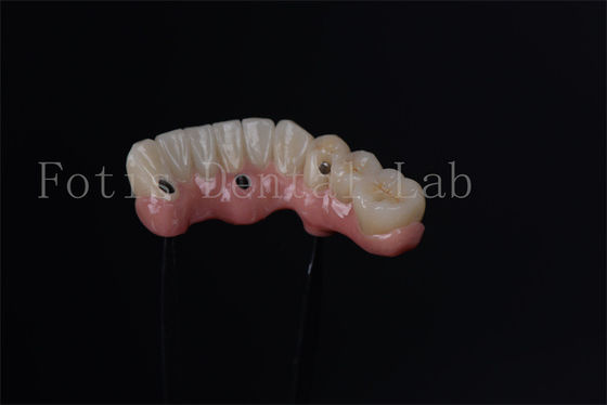 Implantes endostáticos individuales para reemplazo dental inmediato