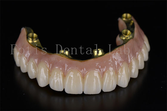 Tratamiento profesional eficiente con 6 implantes para problemas dentales