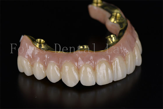 Reconstrucción de la boca completa todo en 4 todo en 6 sistema de implante dental