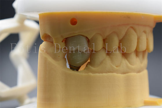 Implante dental personalizable con una corona abutment cómoda para los pacientes