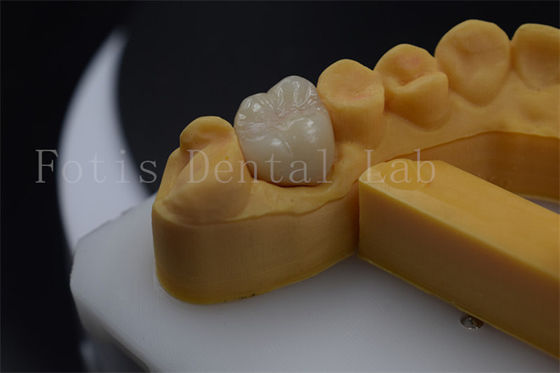 Coronilla de dentadura de titanio / PFM de circonia personalizable Corona de implante duradera